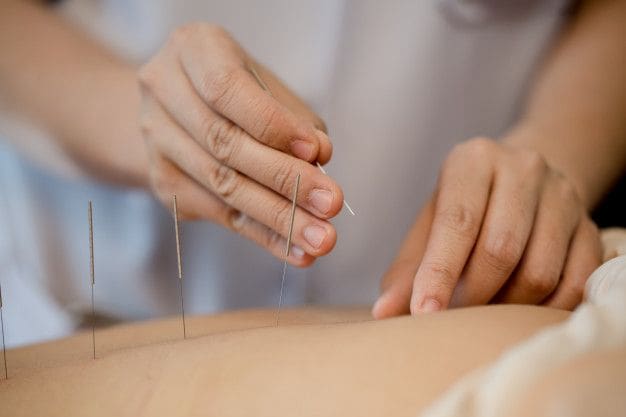 acupuncture for lower back pain