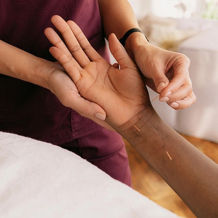 acupuncture for elbow pain mclean