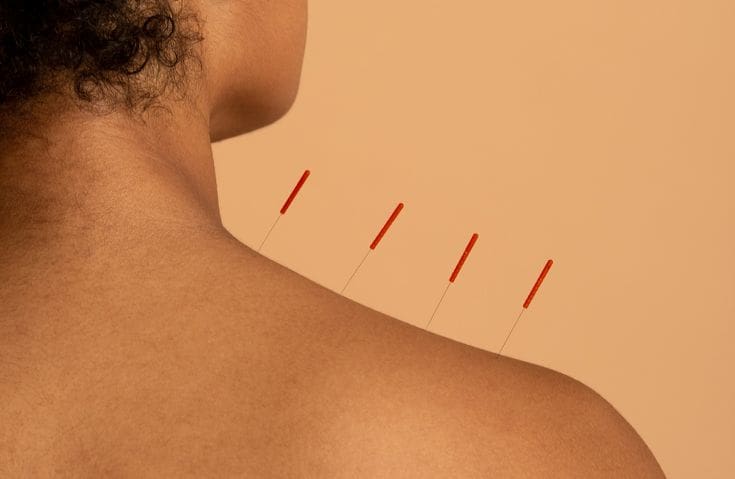acupuncture for neck pain, acupuncture for shoulder pain