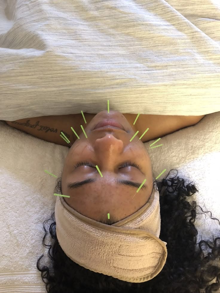 acupuncture for TMJ mclean