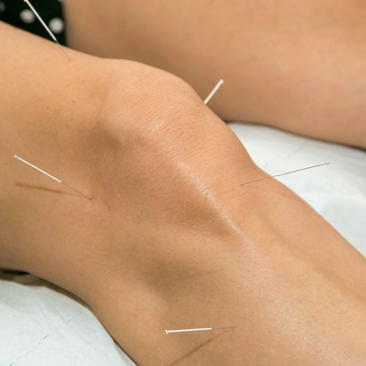 acupuncture for knee pain mclean
